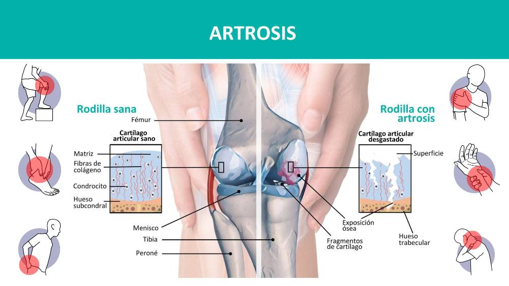 Artrosis enfermedad Degenerativa del cartílago de las articulaciones