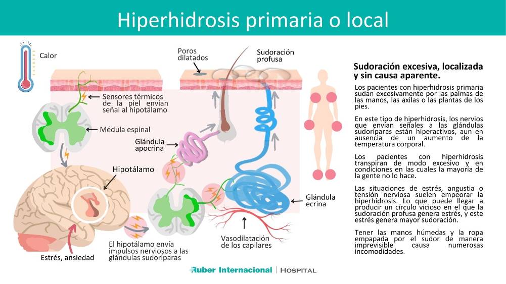 Hiperhidrosis primaria o local Hospital Ruber internacional