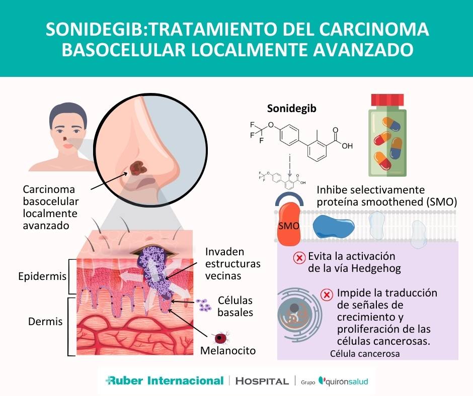 Tratamiento carcinoma basocelular sonidegib