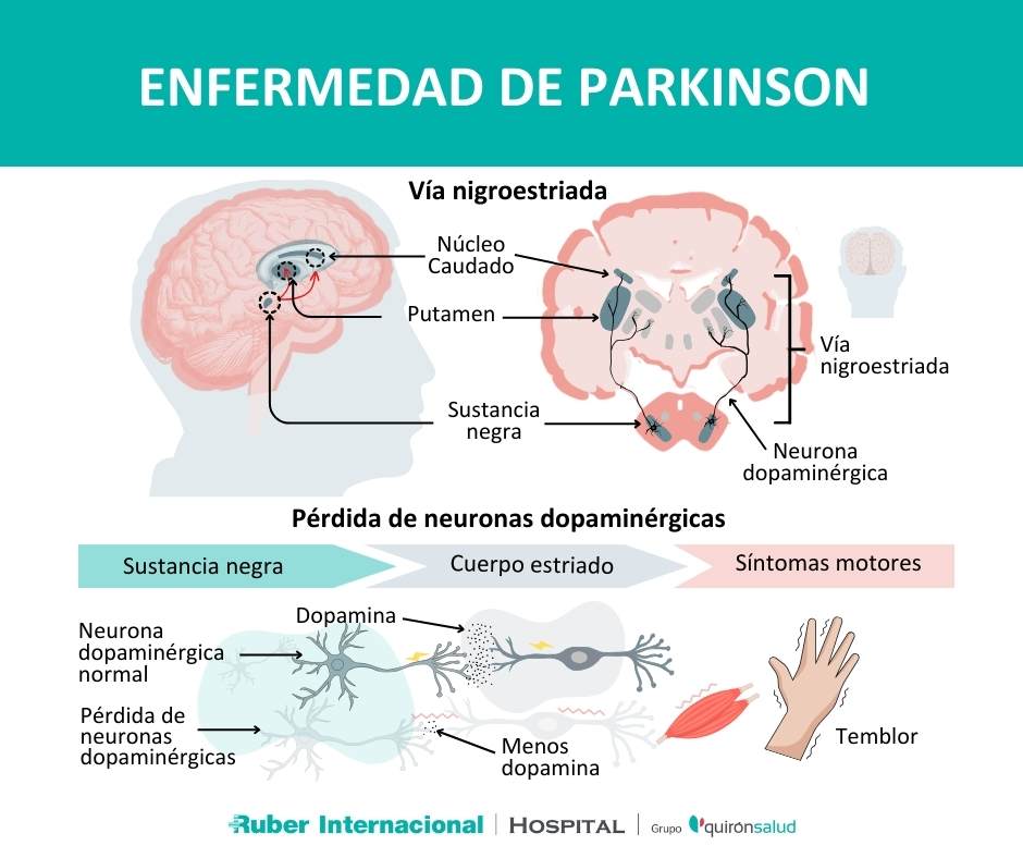 Enfermedad Parkinson Diagnostico