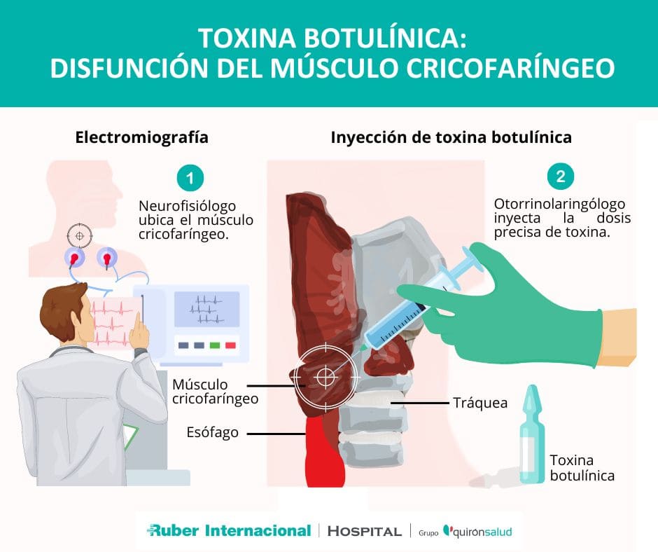 Tratamiento disfagia toxina botulinica cricofaringeo
