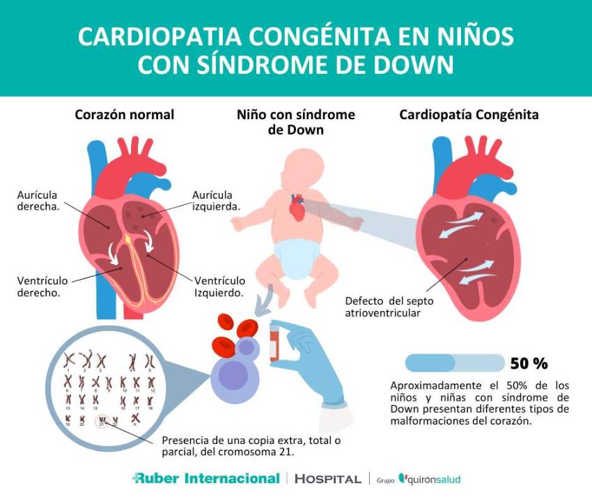 Cardiopatia Congenita sindrome de down