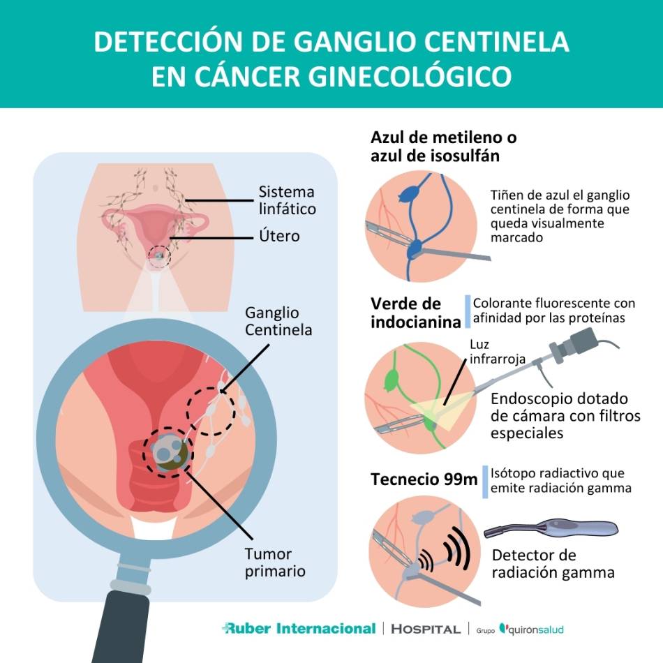 Deteccion de ganglio centinela