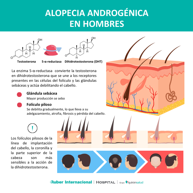 Causas de la alopecia androgénica en hombres