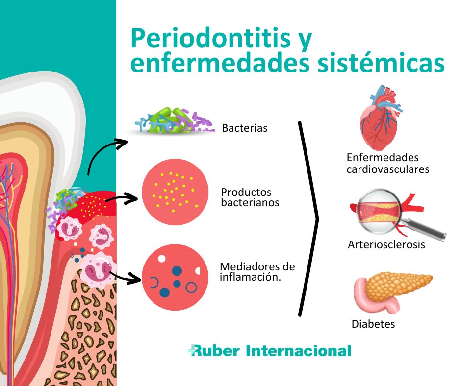 La periodontitis puede influir sobre la salud general