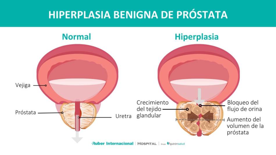 Hiperplasia benigna de próstata HBP