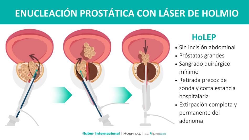 Tratamiento de la hiperplasia benigna de la próstata con láser de holmio