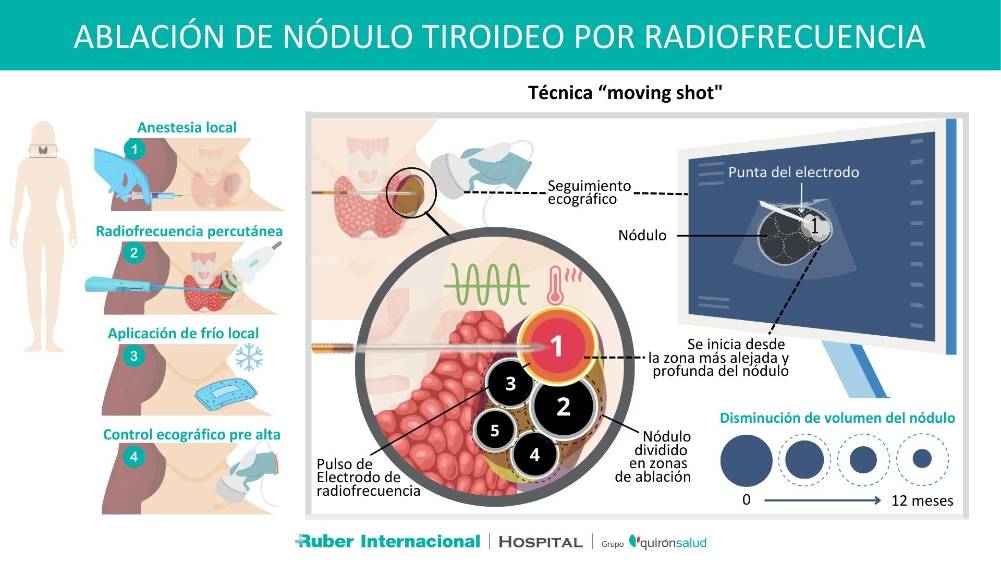 Ablación de nódulo tiroideo por radiofrecuencia hospital ruber internacional