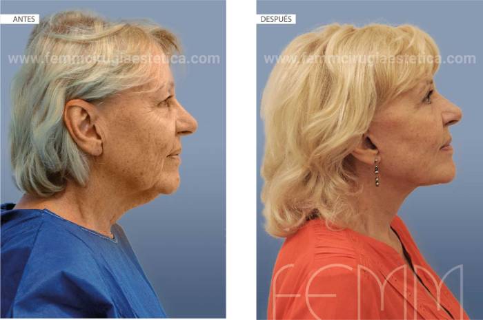 antes y después de una cirugía de lipolifting facial