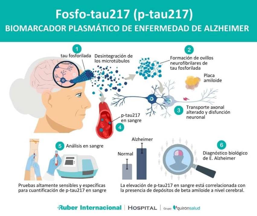 Proteína fosfo tau 217 Alzheimer nueva Diagnóstico