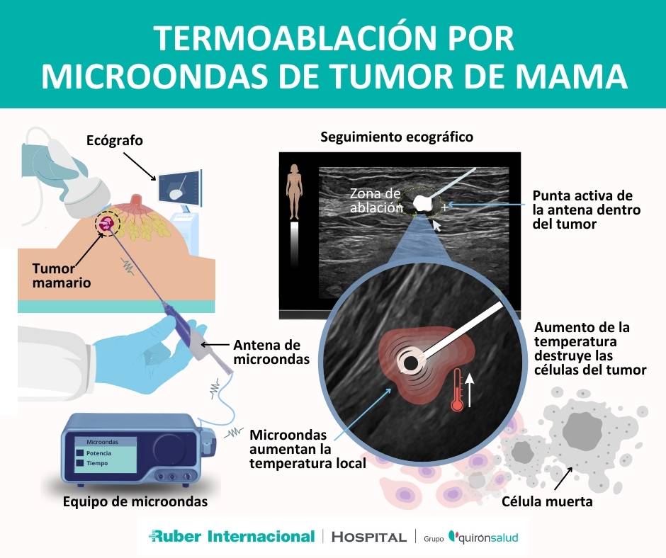 tratamiento cancer de mama termoablación microondas
