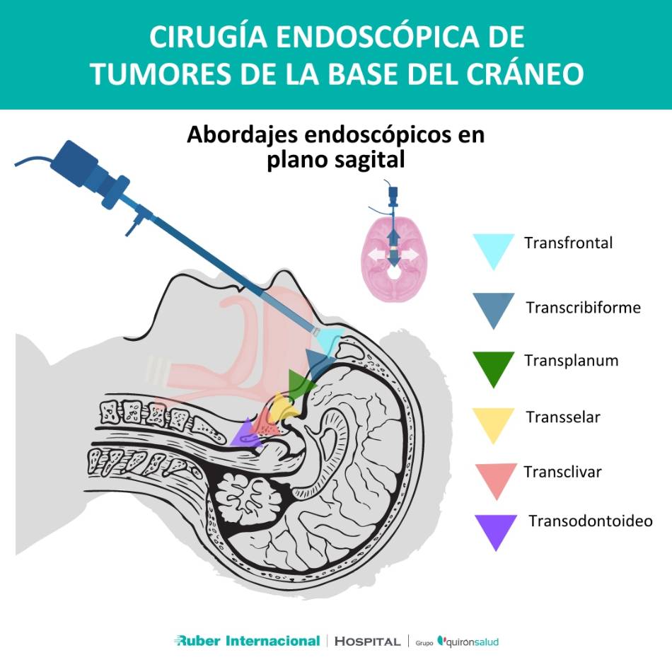 Cirugía endoscópica de tumores de la base del cráneo Ruber Internacional