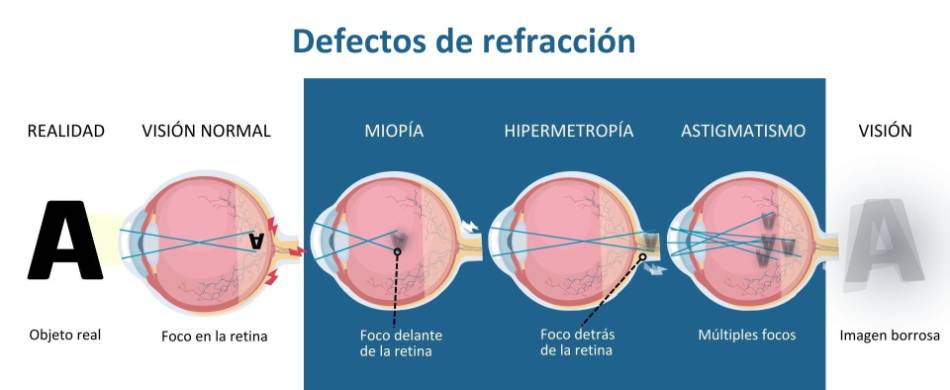 Defectos de refracción Cirugía Láser transepitelial Hospital Ruber Internacional