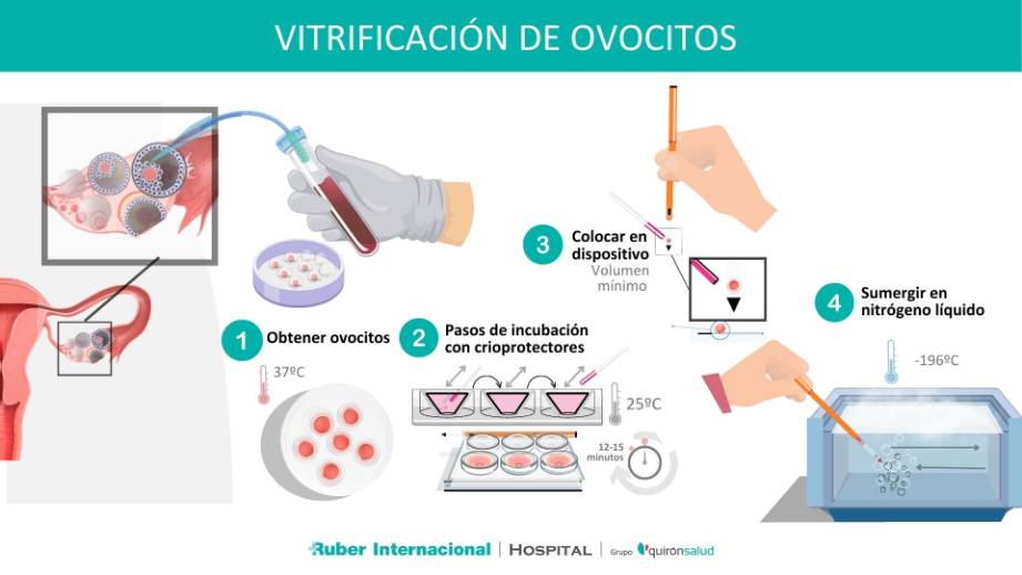 Vitrificación de ovocitos para preservar la fertilidad futura de las mujeres