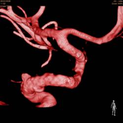 Arteriografía 3D tras la implantación de stent diversor de flujo interna izquierda de gran tamaño (15 mm) en arteria carótida, que muestra trombosisicon cierre total del aneurisma