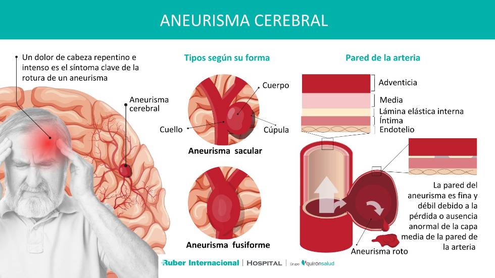 Qué es un aneurisma Cerebral