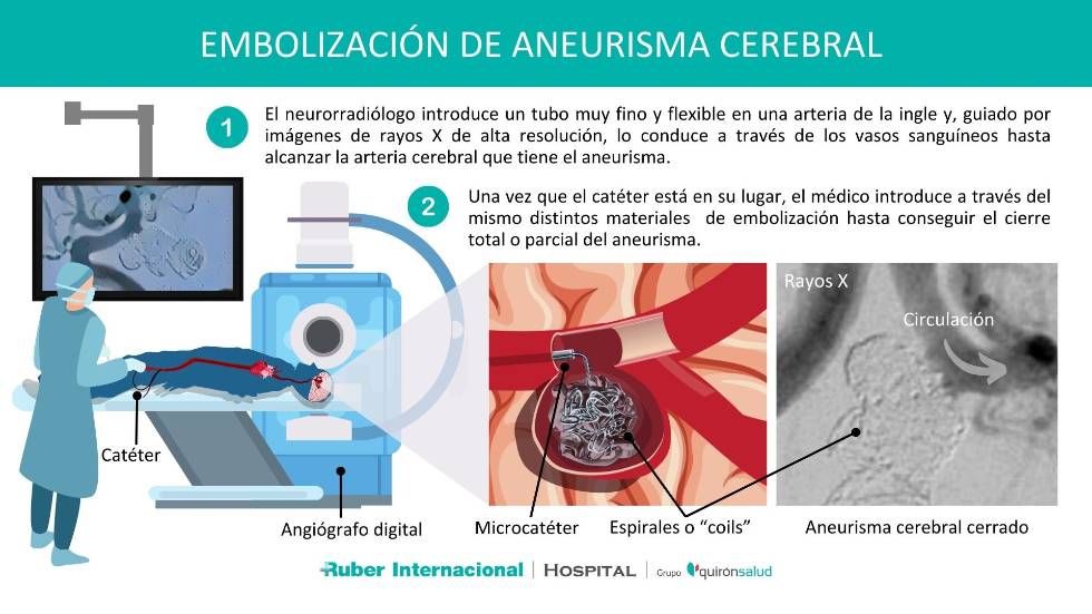 Tratamiento del aneurisma cerebral mediante embolizacion con coils