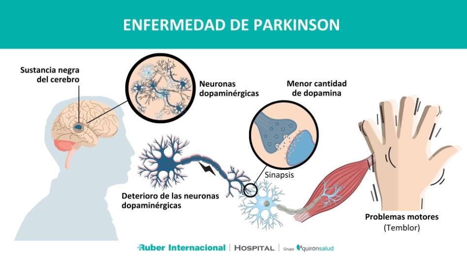 Enfermedad de Parkinson Dra. Kurtis Neurología