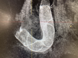 Visualización radiológica del stent diversor de flujo durante su implantación en el procedimiento.