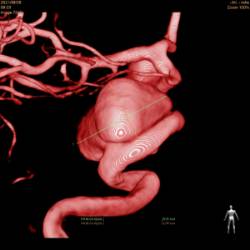 Arteriografía 3D de aneurisma cerebral en carótida Arteriografía 3D tras la implantación de stent diversor de flujo interna izquierda de gran tamaño (15 mm)