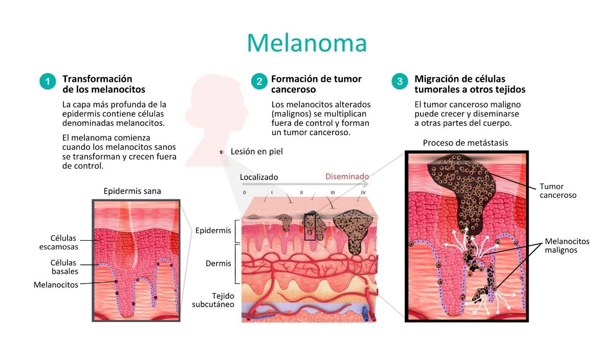 Melanoma Dermatología Ruber Internacional