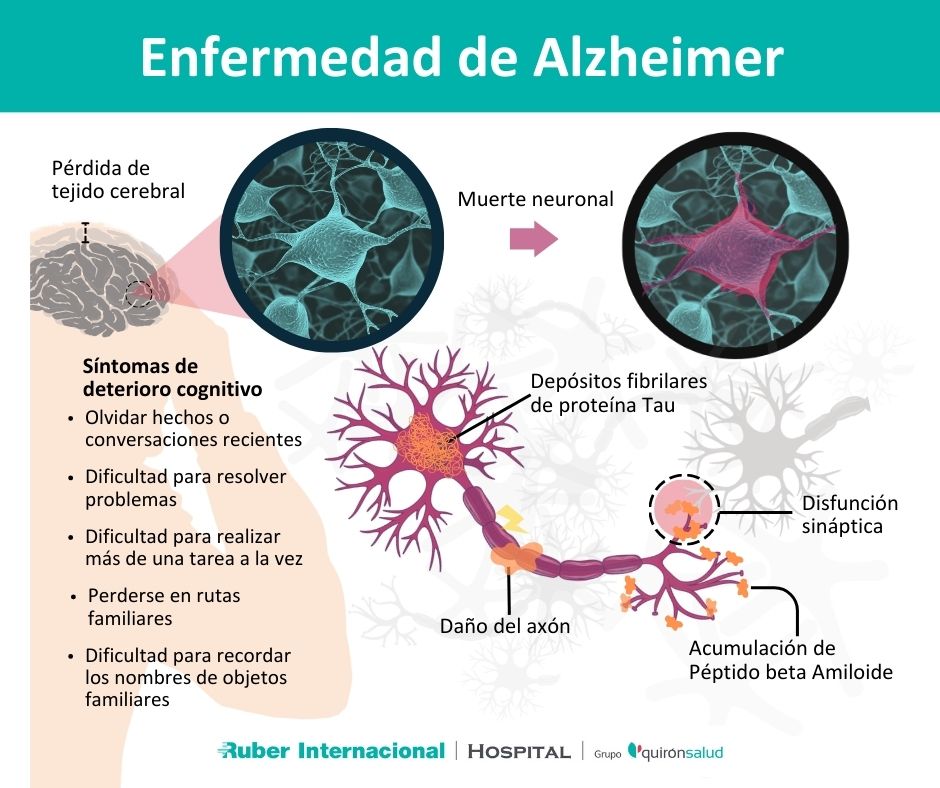 Qué es la enfermedad de Alzheimer
